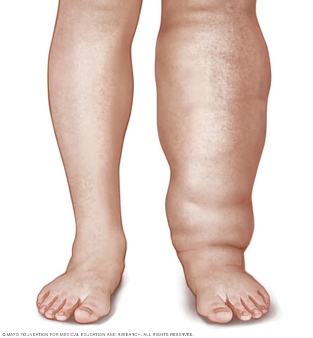 Lymphedema Leg