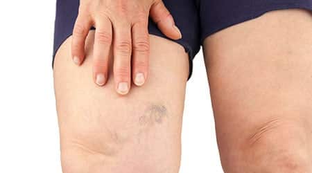 person touching a blue varicose vein on their upper thigh.
