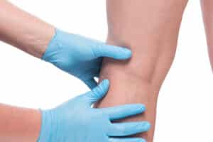 hands of doctor in gloves and leg with dilated veins close up on white background