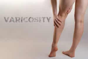 A woman rubs her tired varicose legs with a text VARICOSITY