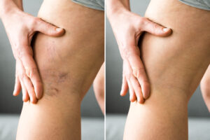 Before,After,Cellulite,Inflammation,Legs,Treatment,Closeup
