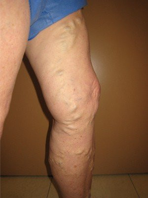 RF Ablation/Sclerotherapy – Case 3