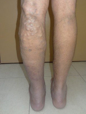 RF Ablation/Sclerotherapy – Case 5