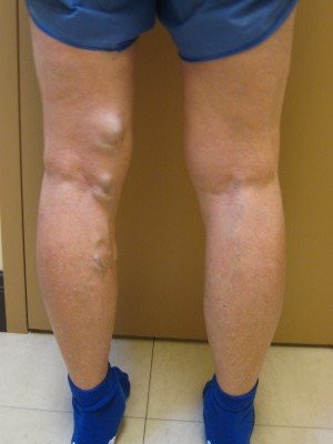 RF Ablation/Sclerotherapy – Case 6