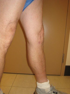 RF Ablation/Sclerotherapy – Case 8