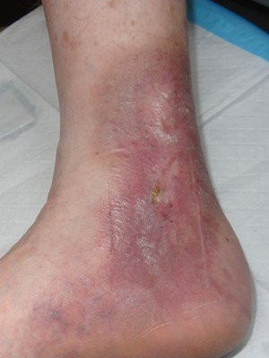 Wound Care/Lymphedema – Case 1