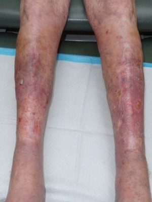 Wound Care/Lymphedema – Case 2