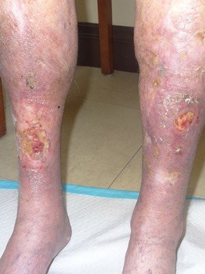 Wound Care/Lymphedema – Case 2