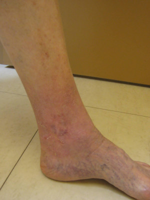 Wound Care/Lymphedema – Case 3
