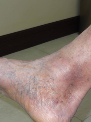 Wound Care/Lymphedema – Case 4