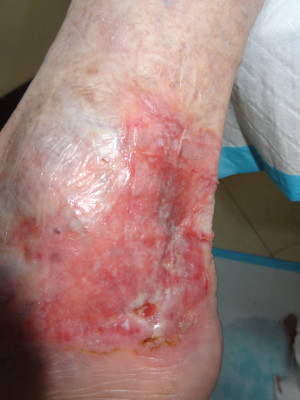 Wound Care/Lymphedema – Case 4